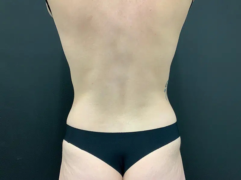 Tummy Tuck Before & After Image