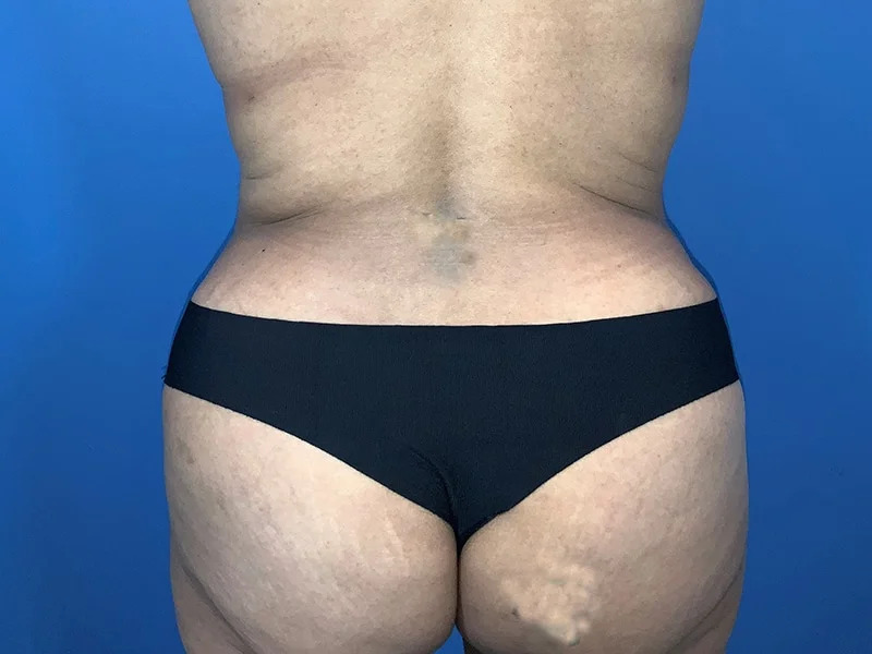 Tummy Tuck Before & After Image