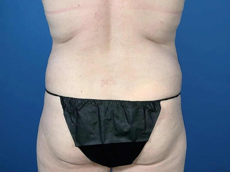 Tummy Tuck Before & After Image