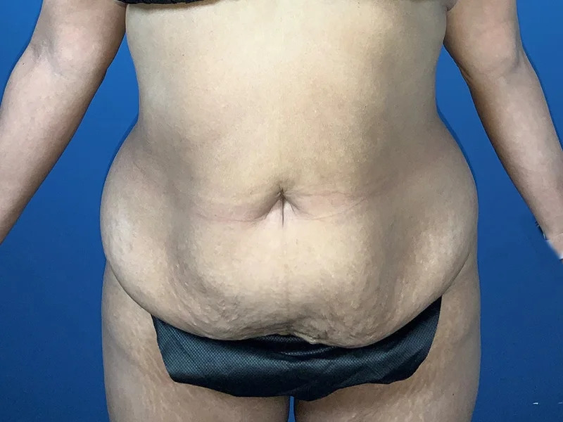 Tummy Tuck Before & After Image