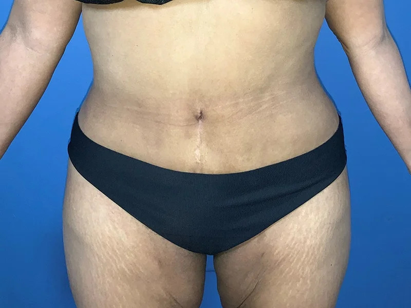 Tummy Tuck Before & After Image