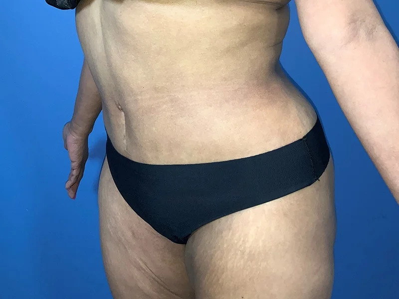 Tummy Tuck Before & After Image