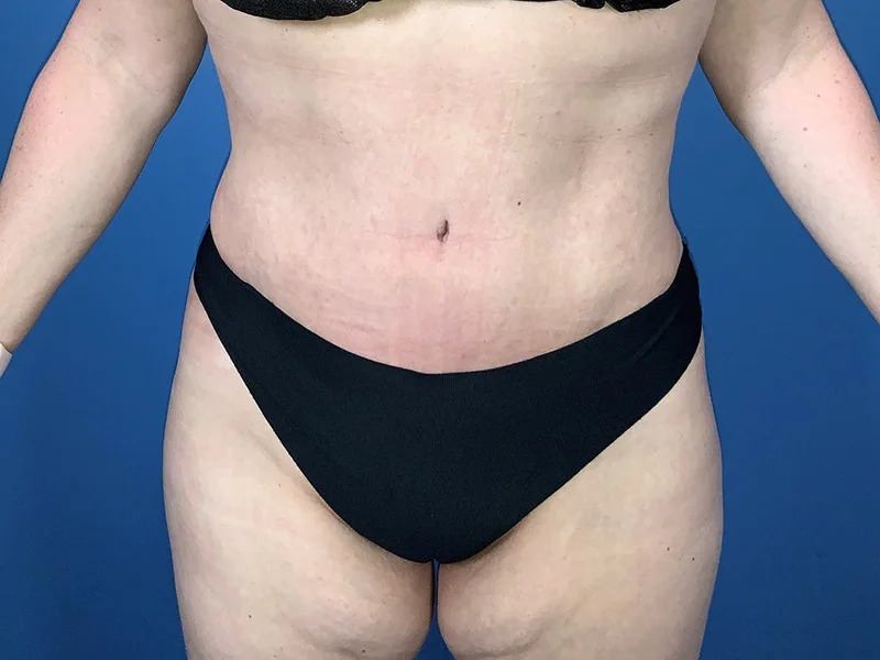 Tummy Tuck Before & After Image