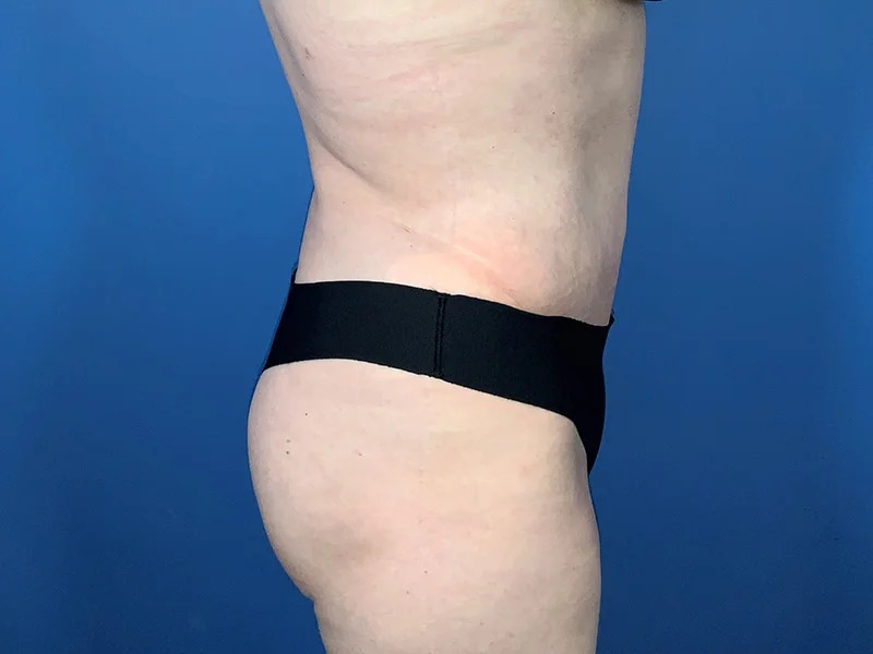 Tummy Tuck Before & After Image