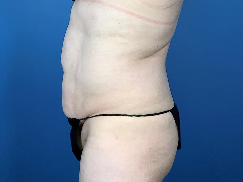 Tummy Tuck Before & After Image