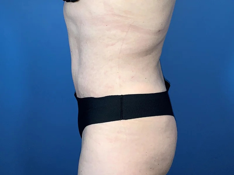 Tummy Tuck Before & After Image