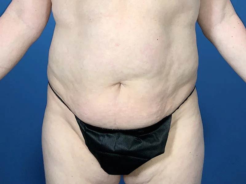 Tummy Tuck Before & After Image