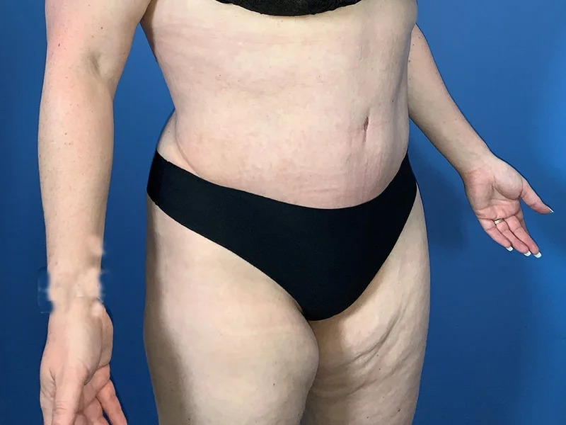 Tummy Tuck Before & After Image