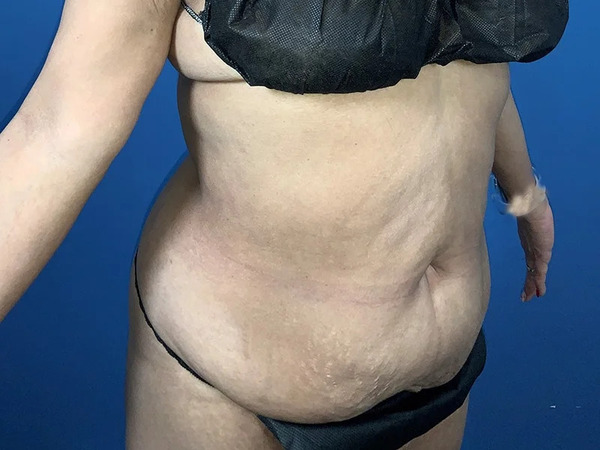 Tummy Tuck Before & After Image