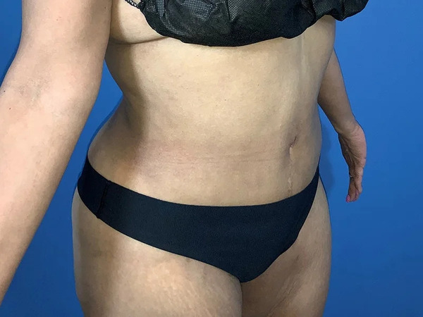 Tummy Tuck Before & After Image