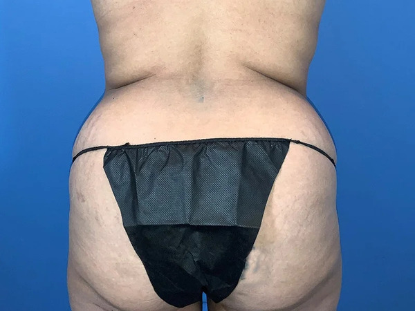 Tummy Tuck Before & After Image