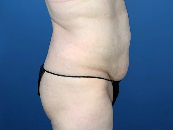 Tummy Tuck Before & After Image