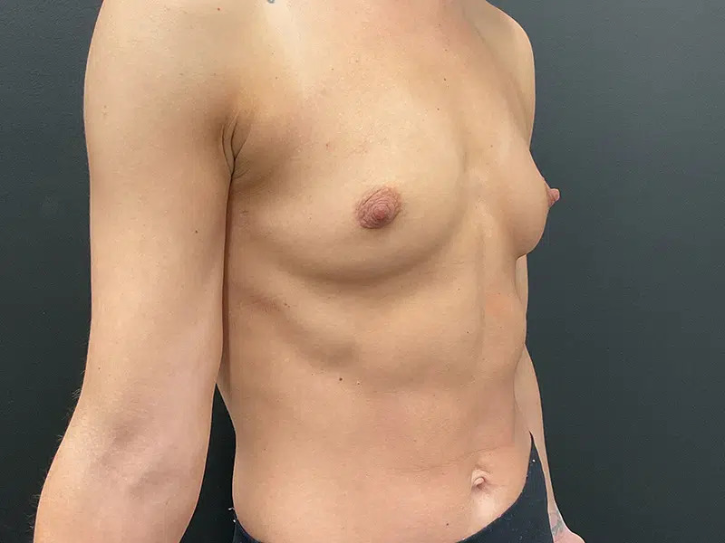 Breast Augmentation Before & After Image