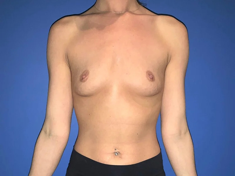 Breast Augmentation Before & After Image