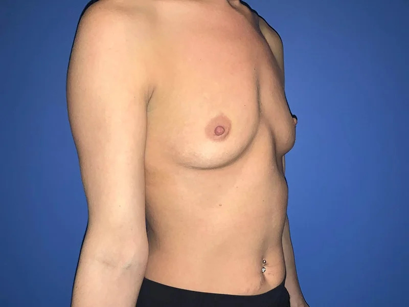 Breast Augmentation Before & After Image