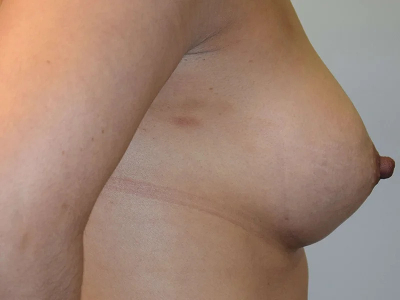 Breast Augmentation Before & After Image