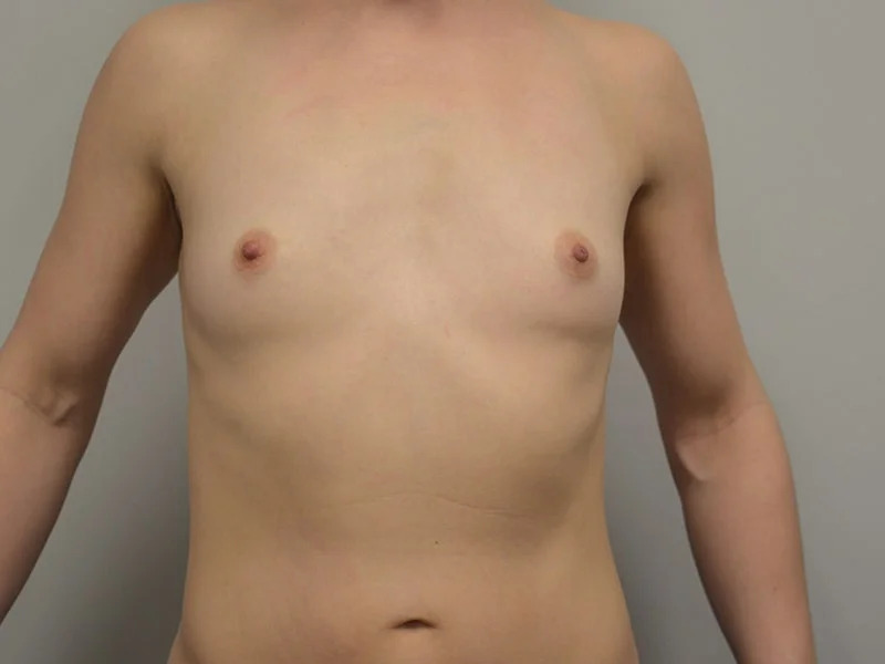 Breast Augmentation Before & After Image