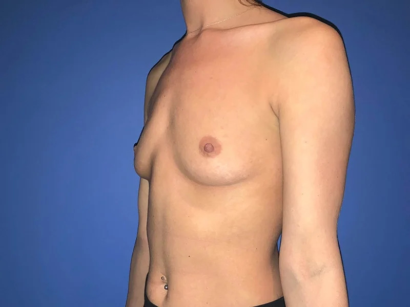 Breast Augmentation Before & After Image