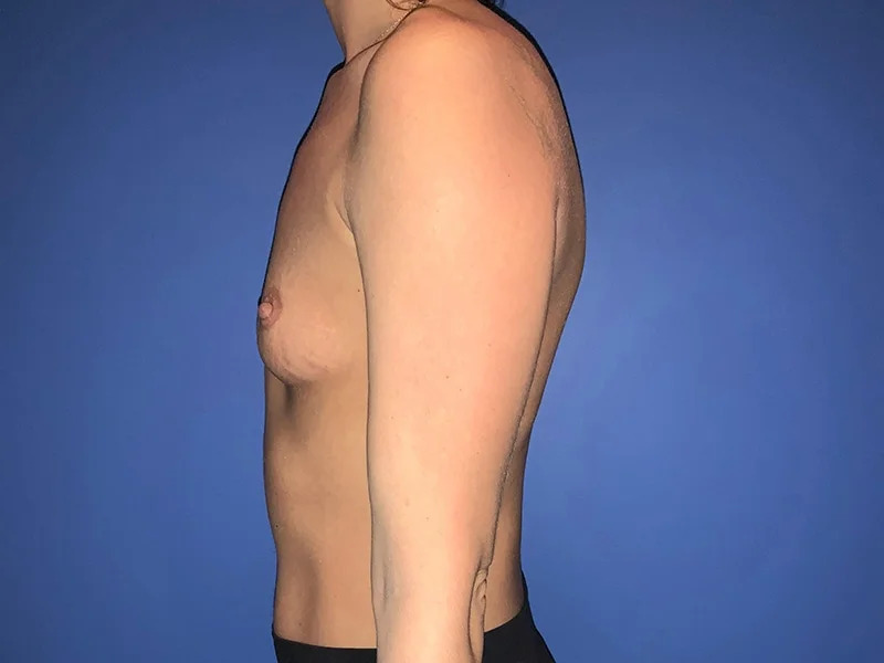 Breast Augmentation Before & After Image