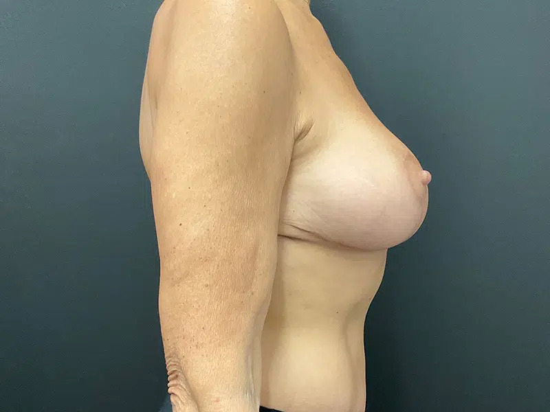 Breast Lift Before & After Image