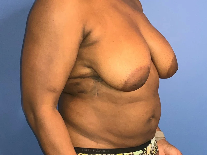 Breast Lift Before & After Image