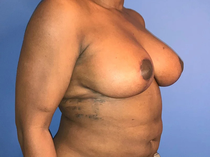 Breast Lift Before & After Image