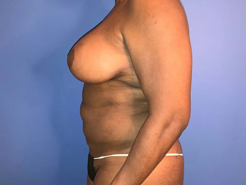 Breast Lift Before & After Image