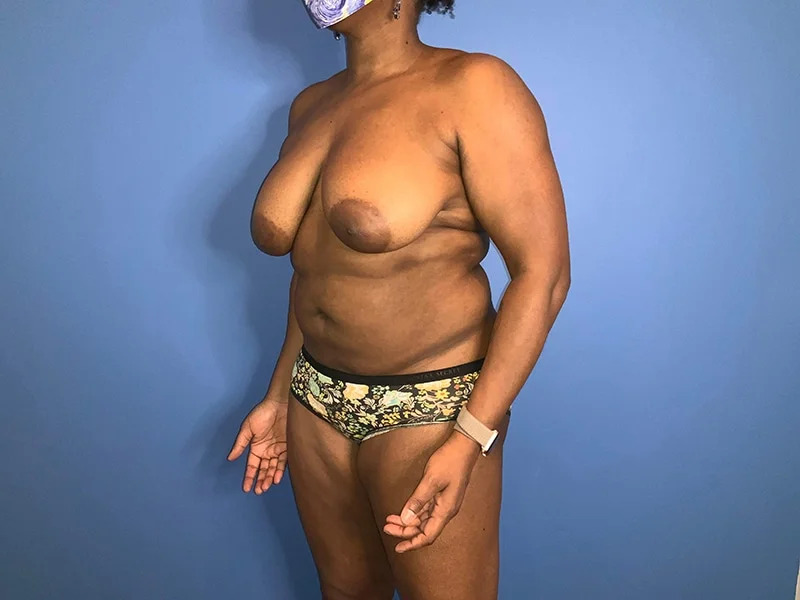 Breast Lift Before & After Image