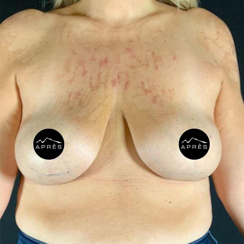 Fat Grafting Before & After Image