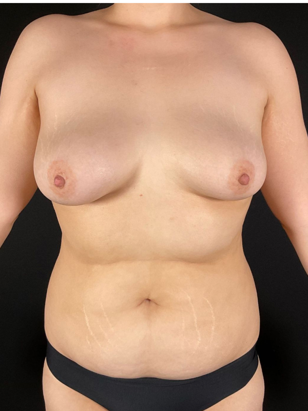 Fat Grafting Before & After Image