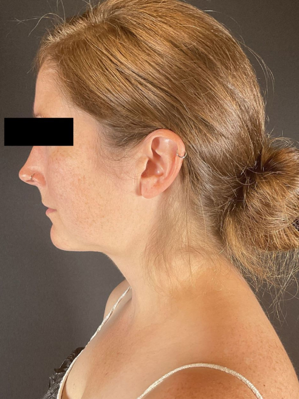 Chin Liposuction Before & After Image