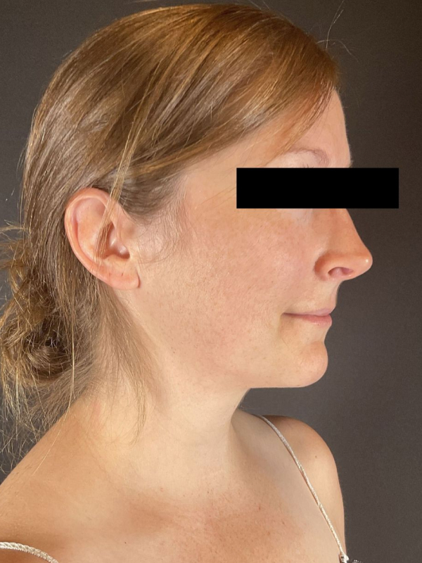 Chin Liposuction Before & After Image