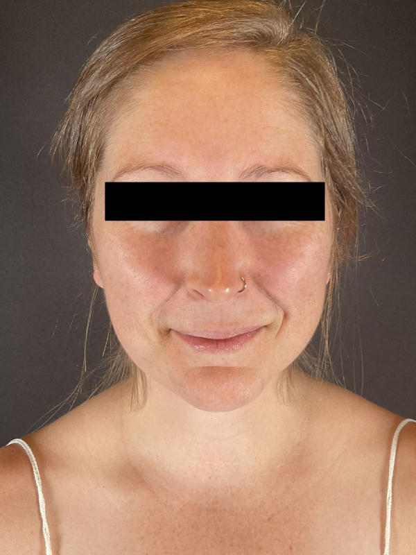 Chin Liposuction Before & After Image