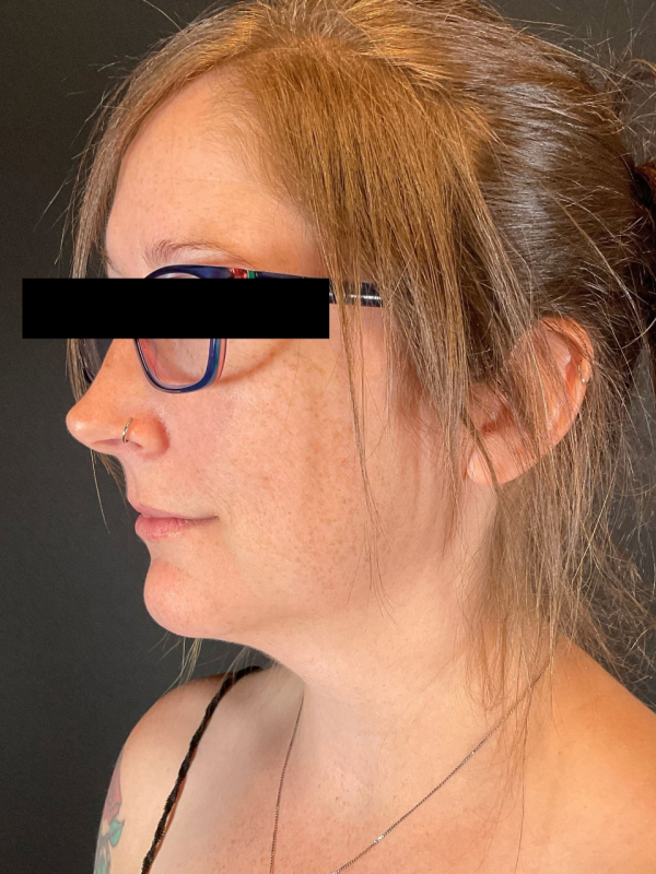 Chin Liposuction Before & After Image