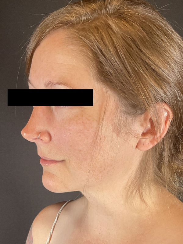 Chin Liposuction Before & After Image